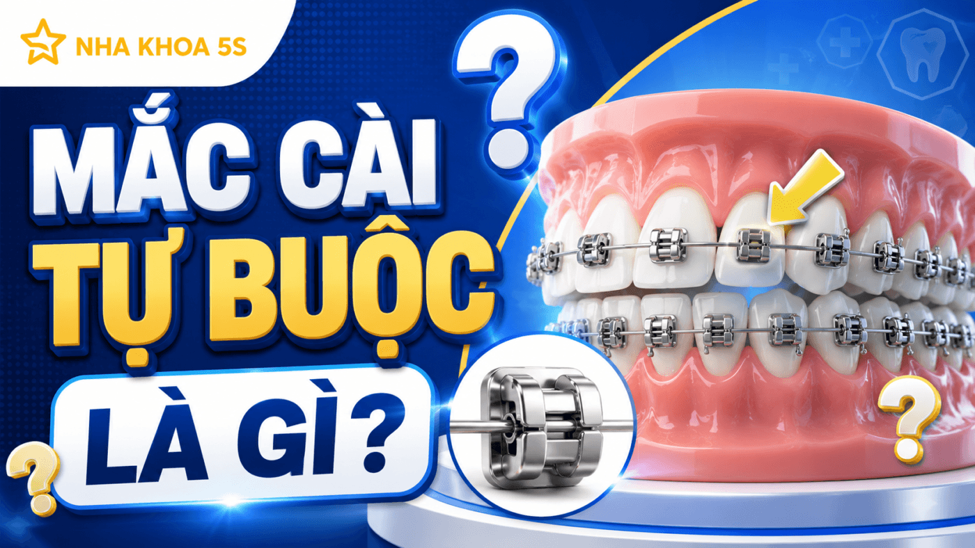 Niềng Răng Mắc Cài Tự Buộc Là Gì