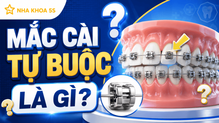 Niềng Răng Mắc Cài Tự Buộc Là Gì