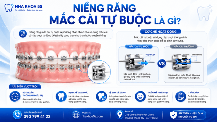 Niềng Răng Mắc Cài Tự Buộc Là Gì? Ưu Nhược Điểm Và Những Điều Cần Biết Trước Khi Chỉnh Nha Niềng Răng Mắc Cài Tự Buộc Là Gì? Ưu Nhược Điểm Và Những Điều Cần Biết Trước Khi Chỉnh Nha