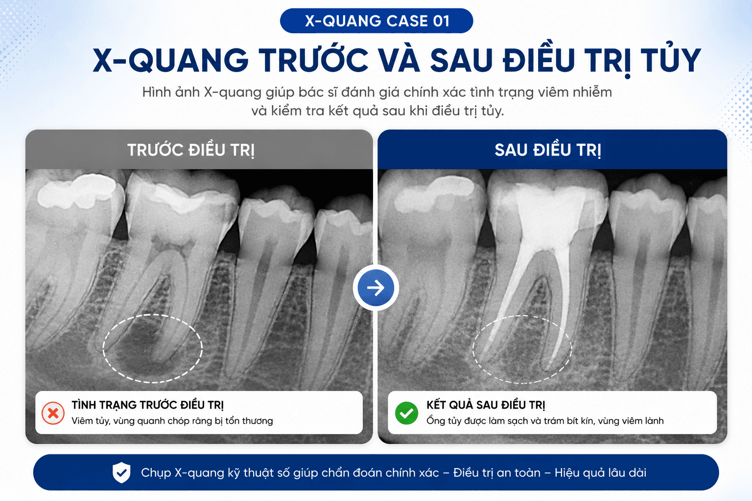 Điều Trị Tủy - An Toàn, Nhanh Chóng, Nhẹ Nhàng 12D31B56 5E7A 4Afc B261 295Dac48D509 15