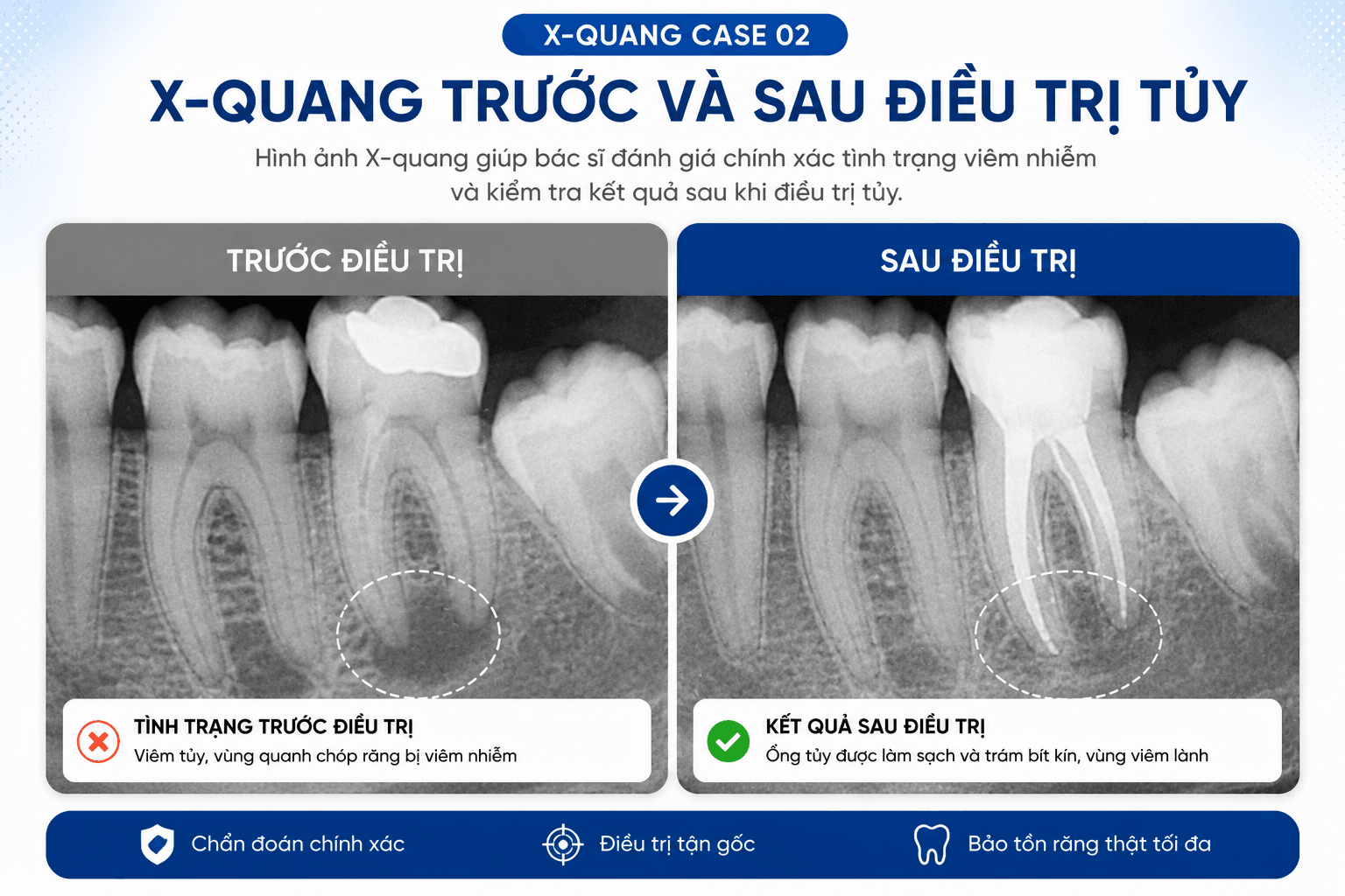 Điều Trị Tủy - An Toàn, Nhanh Chóng, Nhẹ Nhàng 3328C9Da 6E90 4B03 8Ec6 093Ffdc9Bae6 15