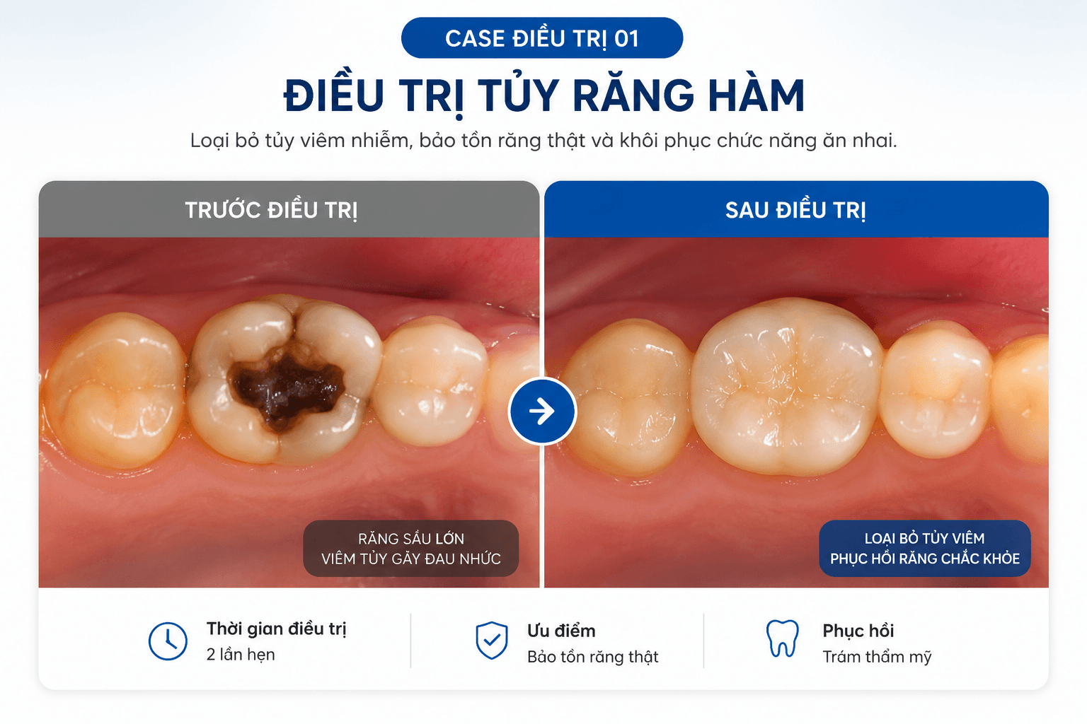 Điều Trị Tủy - An Toàn, Nhanh Chóng, Nhẹ Nhàng 7A84Bf44 Ca41 4F6E Bf6E 5A60E6Fd1343 15