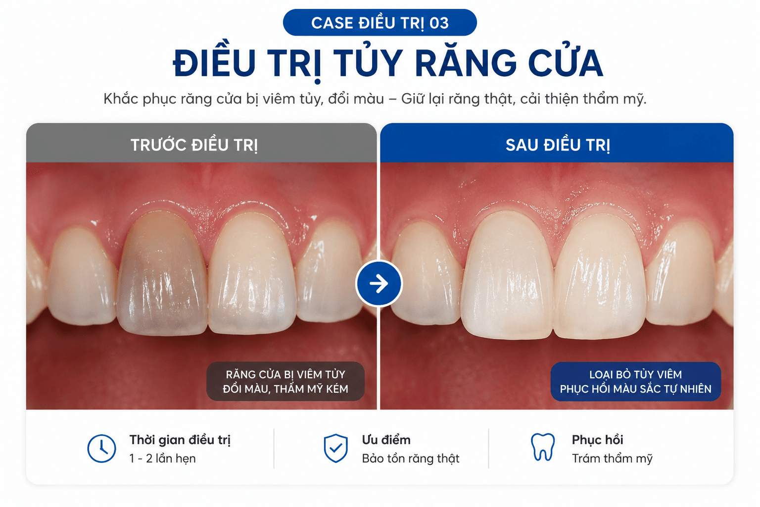 Điều Trị Tủy - An Toàn, Nhanh Chóng, Nhẹ Nhàng 88F491F7 1B5A 47D7 82Ff A67A54A9Eb24 15