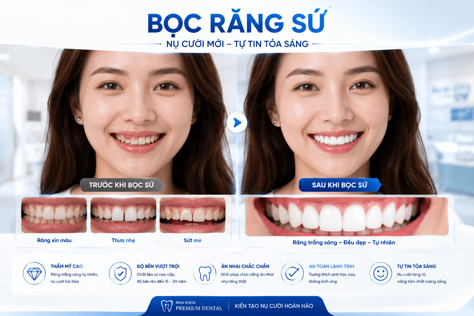 Bọc Sứ Là Gì? Tất Tần Tật Về Bọc Răng Sứ Thẩm Mỹ Bạn Nên Biết Bọc Sứ Là Gì? Tất Tần Tật Về Bọc Răng Sứ Thẩm Mỹ Bạn Nên Biết