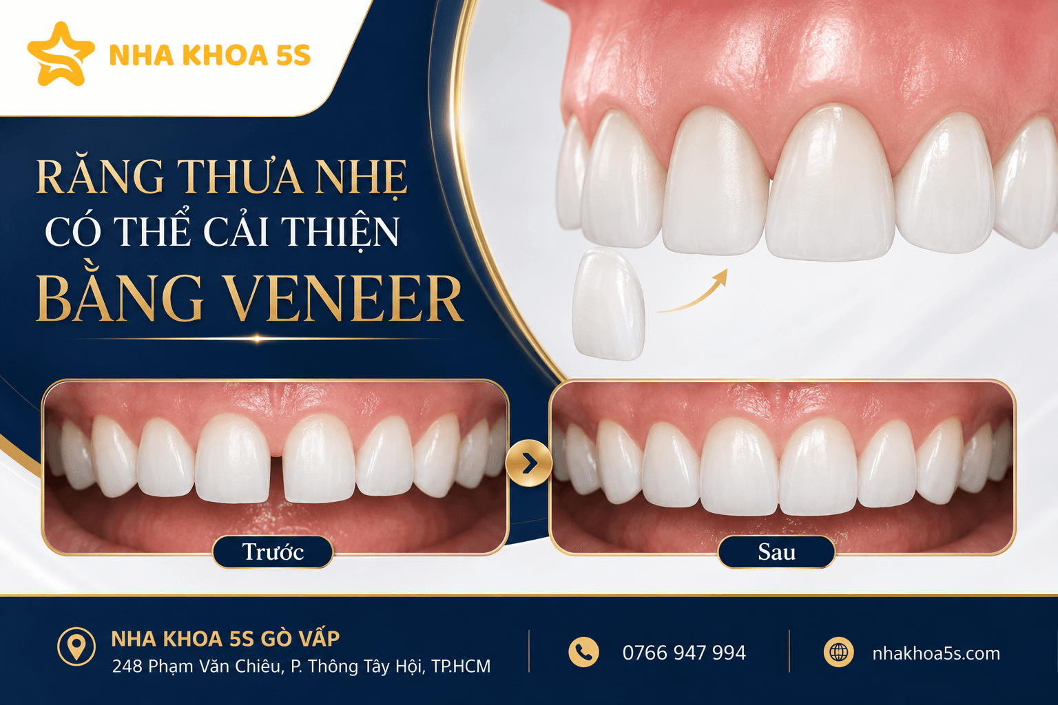 Ai Phù Hợp Dán Sứ Veneer? Tìm Hiểu Các Trường Hợp Răng Xỉn Màu, Thưa Nhẹ, Mẻ Nhỏ, Răng Nhỏ, Lệch Nhẹ Và Người Muốn Bảo Tồn Răng Thật Khi Làm Veneer
