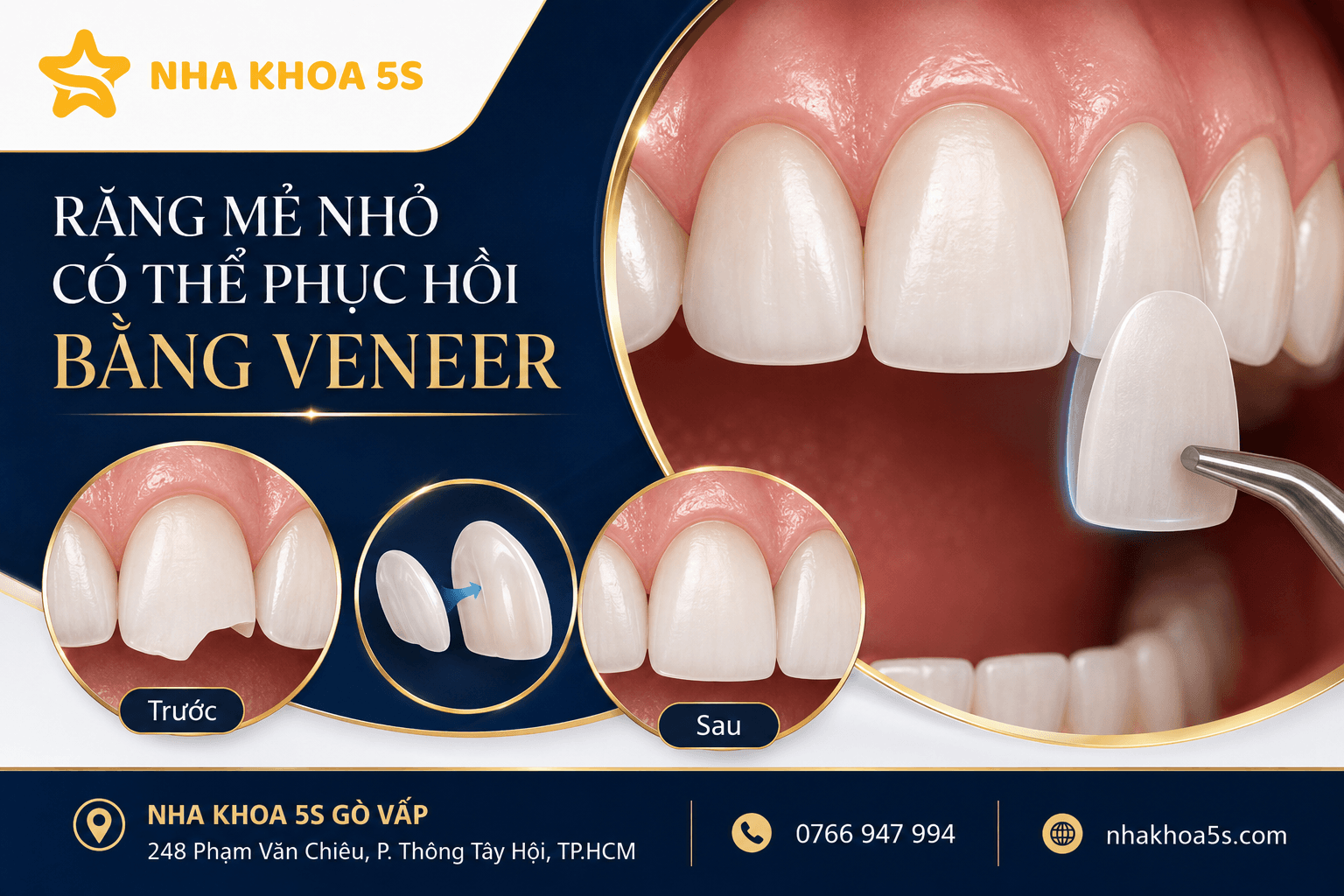 Ai Phù Hợp Dán Sứ Veneer? Tìm Hiểu Các Trường Hợp Răng Xỉn Màu, Thưa Nhẹ, Mẻ Nhỏ, Răng Nhỏ, Lệch Nhẹ Và Người Muốn Bảo Tồn Răng Thật Khi Làm Veneer