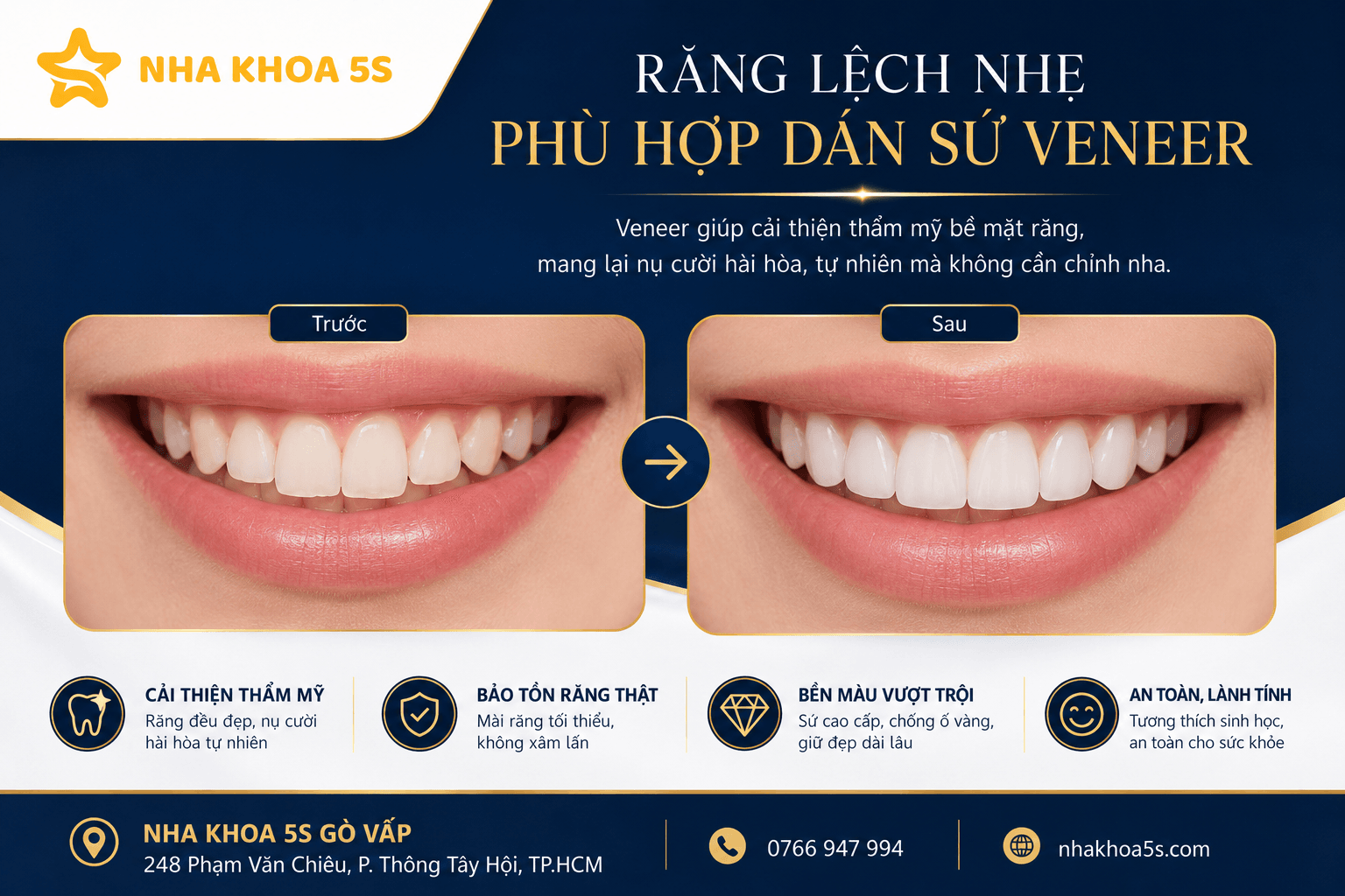 Ai Phù Hợp Dán Sứ Veneer? Tìm Hiểu Các Trường Hợp Răng Xỉn Màu, Thưa Nhẹ, Mẻ Nhỏ, Răng Nhỏ, Lệch Nhẹ Và Người Muốn Bảo Tồn Răng Thật Khi Làm Veneer