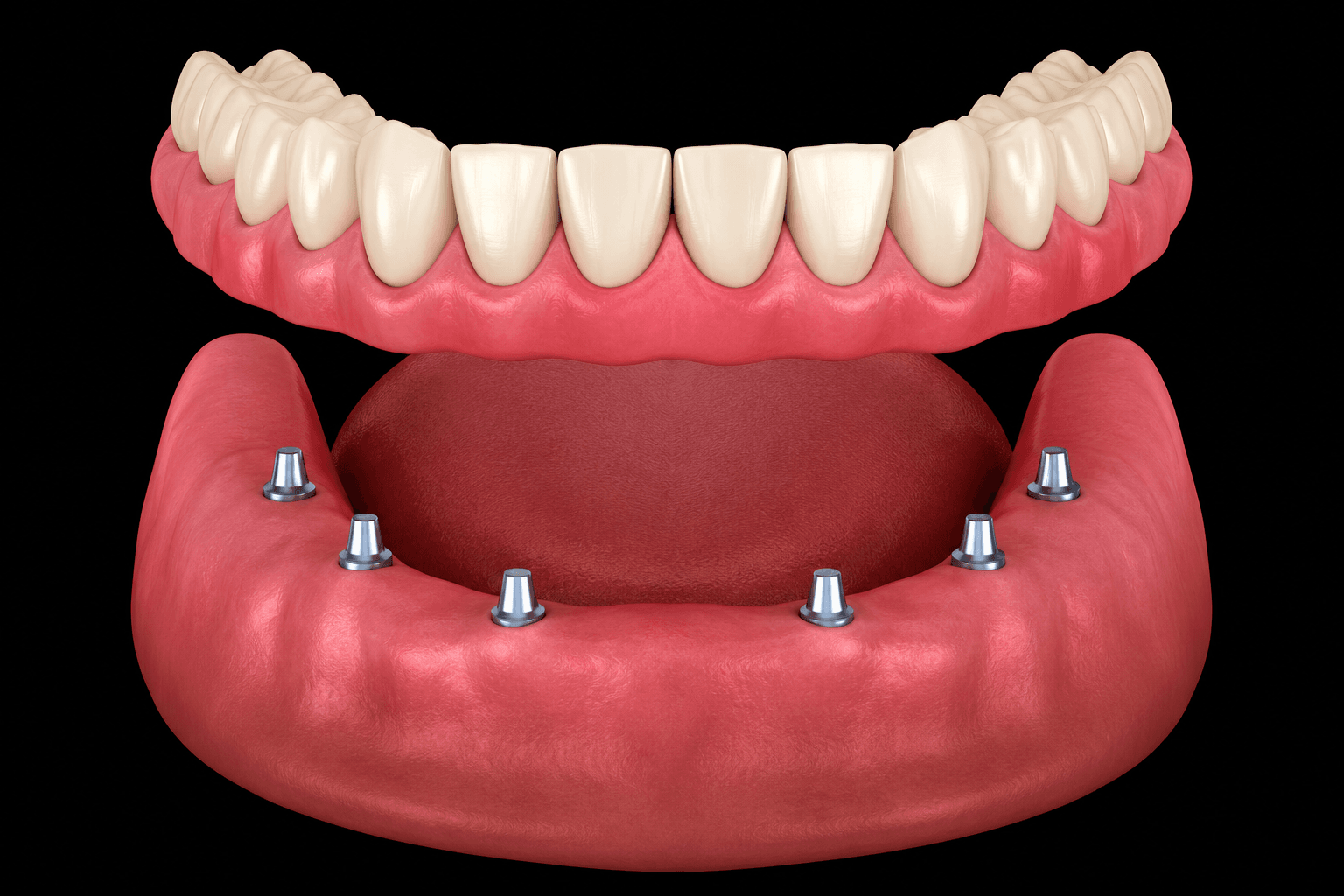 Phục Hình Tháo Lắp – Cải Thiện Thẩm Mỹ Nụ Cười Phục Hình Tháo Lắp Trên Trụ Implant