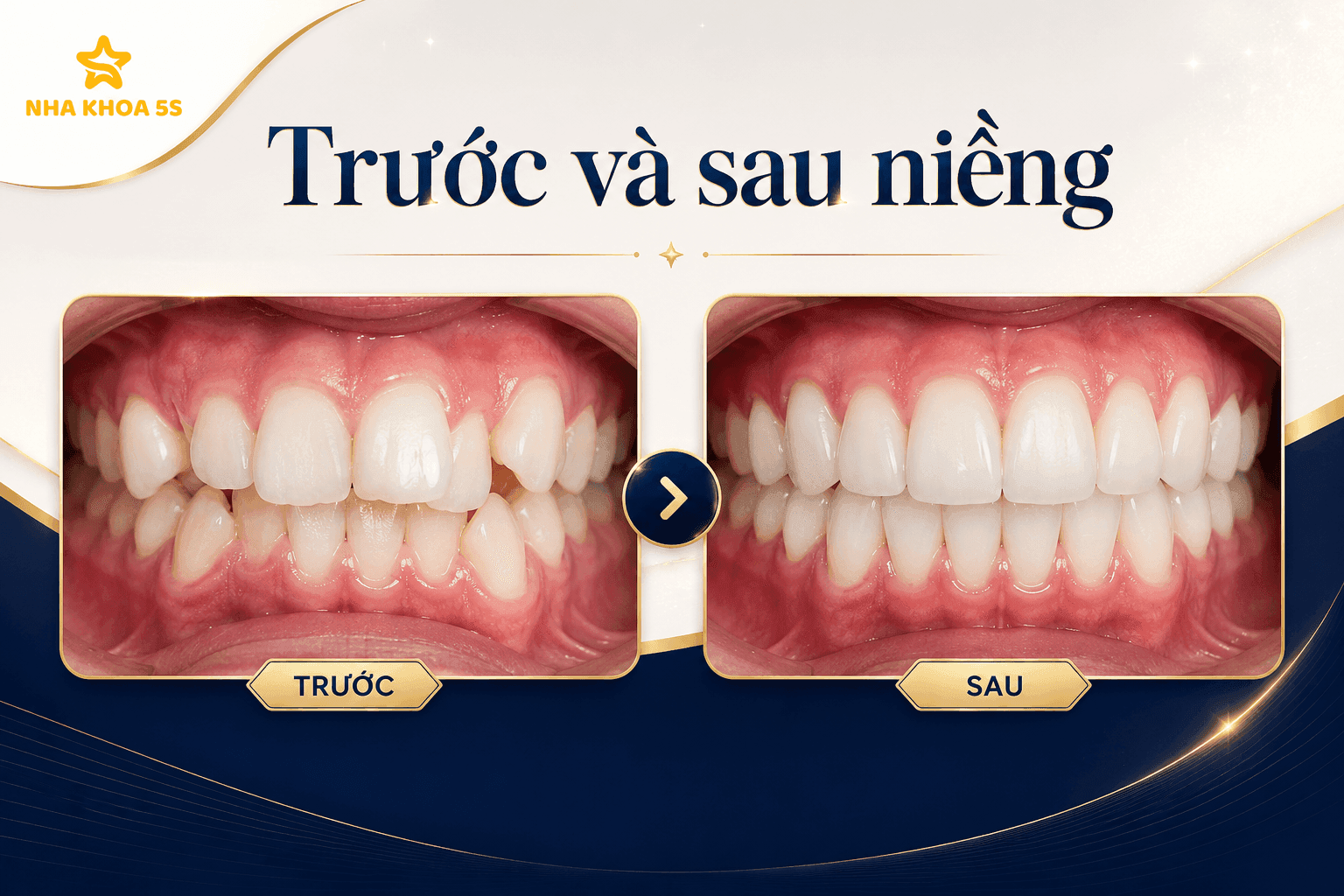 Bảng Giá Niềng Răng Cho Người Lớn Mới Nhất 2026 – Chi Phí Bao Nhiêu? Nên Chọn Phương Pháp Nào?