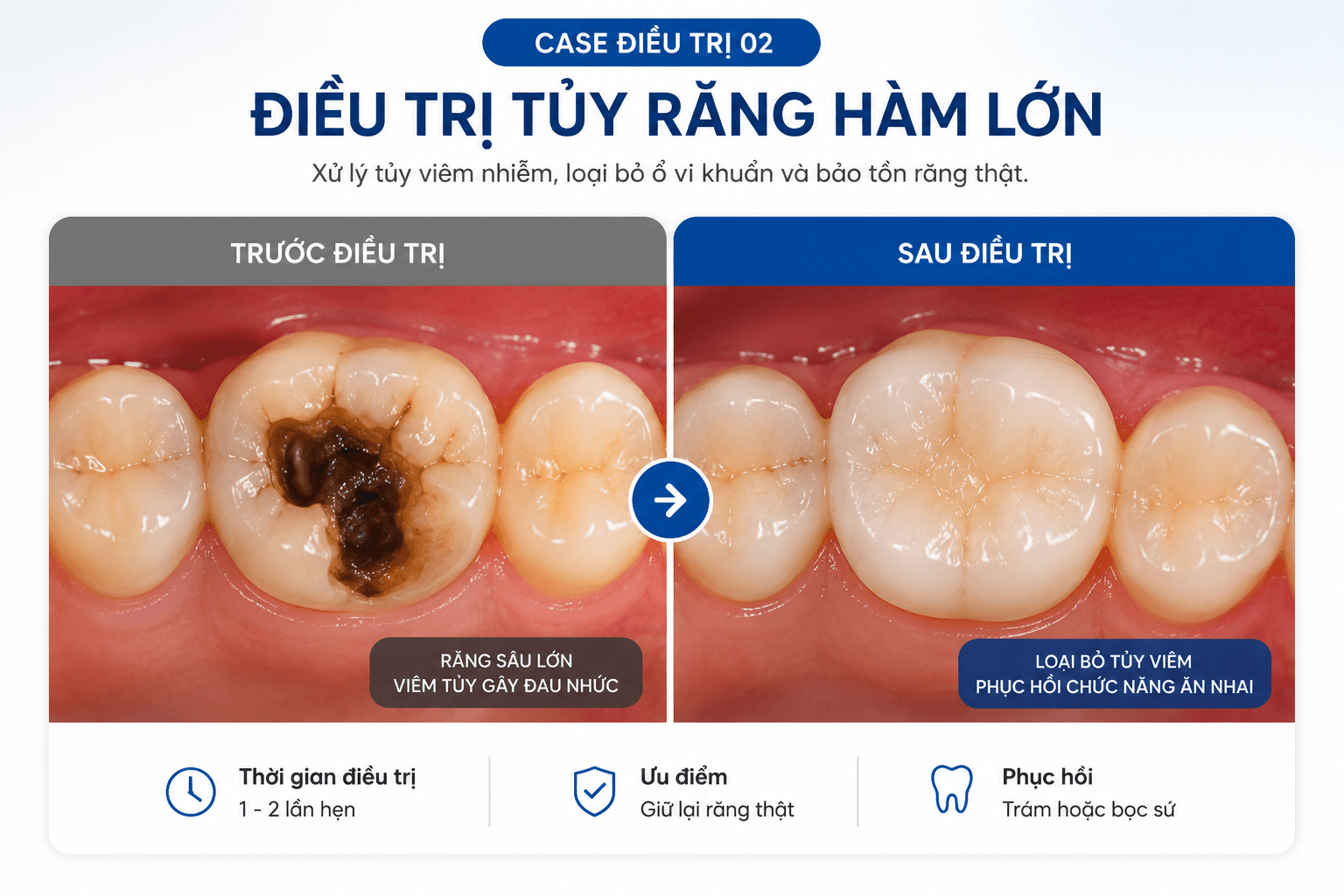 Điều Trị Tủy - An Toàn, Nhanh Chóng, Nhẹ Nhàng E42Ed864 704C 4944 9937 1C7A89E4Eb82 15