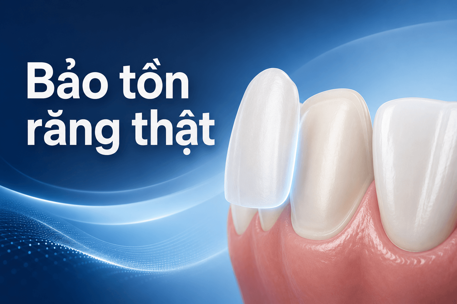 Veneer Thẩm Mỹ Tự Nhiên