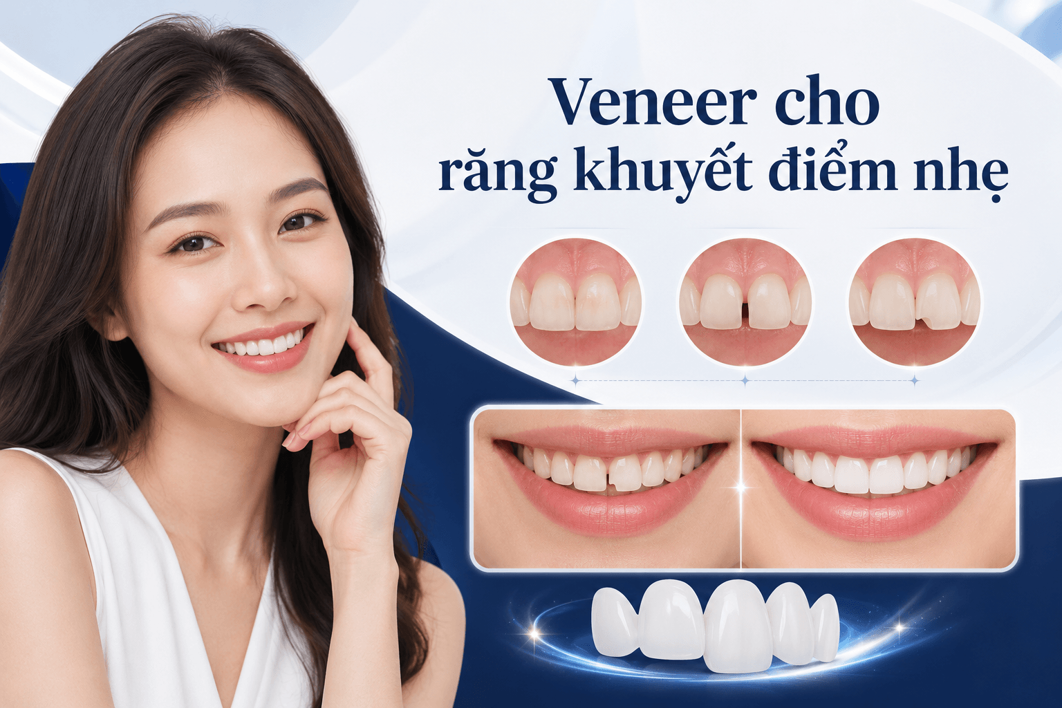Veneer Thẩm Mỹ Tự Nhiên