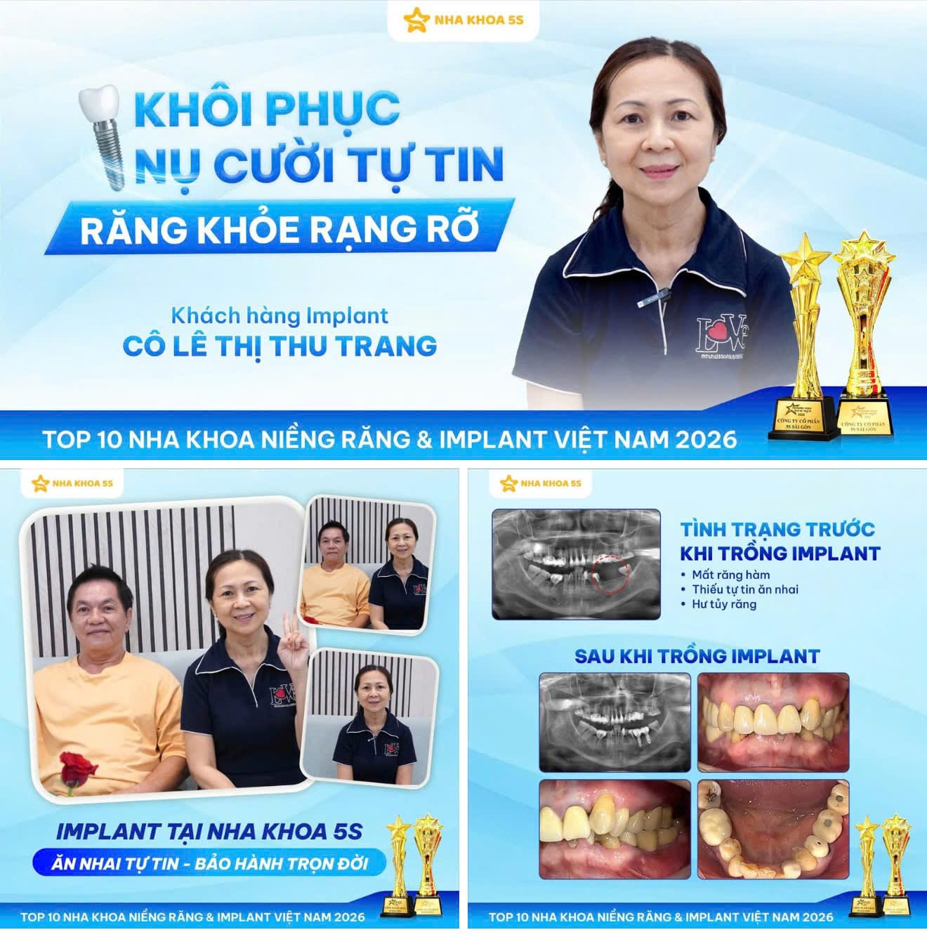 Nha Khoa 5S | Nha Khoa Gò Vấp, Hồ Chí Minh Implant Kh 2
